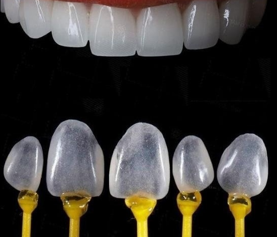 Có bao nhiêu loại mặt dán sứ? Loại nào là tốt nhất và phổ biến nhất hiện nay?