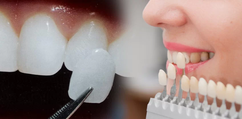 Có bao nhiêu loại mặt dán sứ? Loại nào là tốt nhất và phổ biến nhất hiện nay?