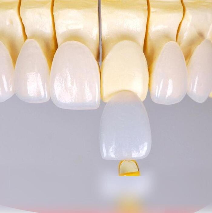 Mặt dán sứ là kỹ thuật phục hình giúp bảo tồn răng thật.